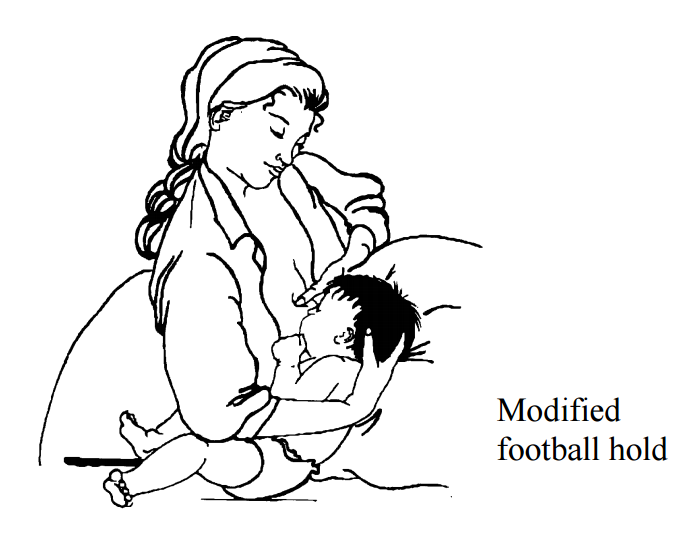 Breastfeeding An Infant With Cleft Lip Childrens - 