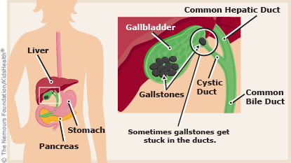A to Z Cholelithiasis Gallstones