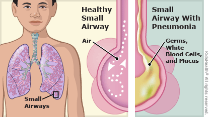 bacterial pneumonia cell