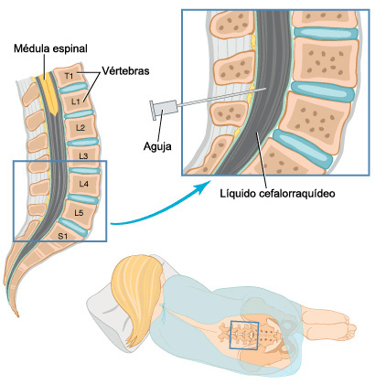 puncion lumbar