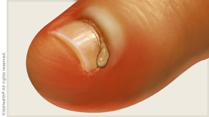 Paronychia