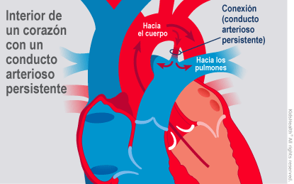 Illustration: Patent Ductus Arteriosus