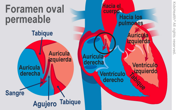 Illustration: Patent Foramen Ovale