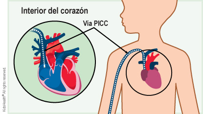 Se muestra una vía PICC en una vena del brazo derecho de un niño que llega hasta dentro del corazón. Esta vía proporciona acceso intravenoso a largo plazo para administrar medicamentos, nutrientes y hacer extracciones de sangre.