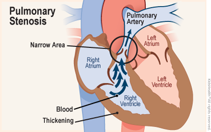 Cross section diagram of a heart shows pulmonary stenosis — where the valve between the right ventricle and the pulmonary artery is too narrow and restricts blood flow.  In some cases, this condition produces a thickening of the ventricle muscles.