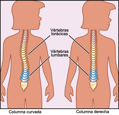 Radiografia escoliosis