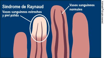 Ilustración que muestra los dedos de la mano de un niño con síndrome de Raynaud, como se describe en el artículo. Un dedo tiene vasos sanguíneos normales debajo de la piel con un color normal. El otro dedo tiene la punta de los dedos con vasos sanguíneos estrechos debajo de una piel pálida.