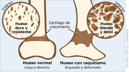 Se muestra un hueso sano y derecho y un hueso débil y arqueado como consecuencia del raquitismo.