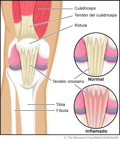 Rodilla de saltador