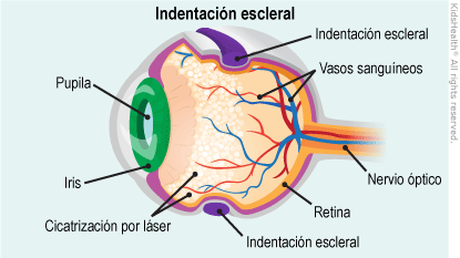 ilustracion introflexion escleral