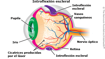 ilustracion introflexion escleral ilustracion introflexion escleral