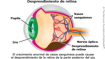 ilustracion desprendimiento de retina ilustracion desprendimiento de retina