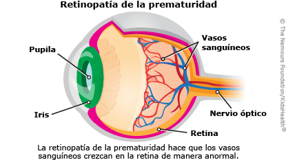 ilustracion retinopatia de la prematuridad