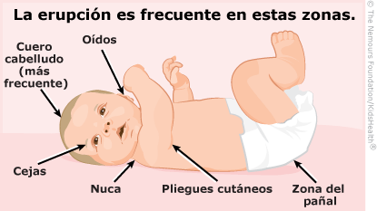 Lugares donde el bebé puede tener dermatitis