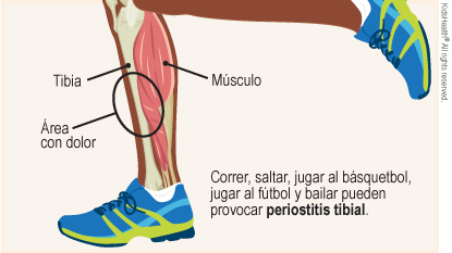 El diagrama muestra la tibia, el músculo y el área con dolor en la espinilla. Correr, saltar, jugar al básquetbol, jugar al fútbol y bailar pueden provocar periostitis tibial.