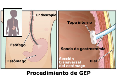 sonda de gastrostomia