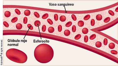 Ilustración que muestra un glóbulo rojo normal con forma de disco. La ilustración también muestra el glóbulo rojo de una persona con esferocitosis hereditaria, el cual tiene la forma de una esfera.