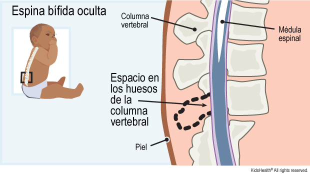 La ilustración de la espina bífida oculta muestra la médula espinal, la columna vertebral, la piel y el espacio en los huesos de la columna vertebral.