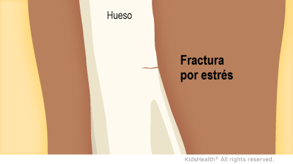 Fractura por estrés