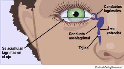 Se muestra la ubicación del conducto lagrimal y el conducto nasolagrimal. Cuando el conducto está bloqueado por tejido, las lágrimas no pueden drenarse y se acumulan en el ojo. Cuando la obstrucción se elimina mediante cirugía, las lágrimas pueden drenarse.