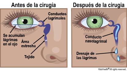Se muestra la ubicación del conducto lagrimal y el conducto nasolagrimal. Cuando el conducto está bloqueado por tejido, las lágrimas no pueden drenarse y se acumulan en el ojo. Cuando la obstrucción se elimina mediante cirugía, las lágrimas pueden drenarse.