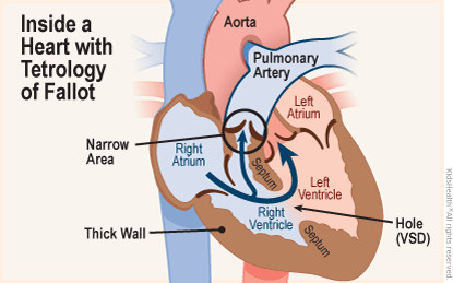 Cross section diagram of a heart shows tetrology of fallot — a critical congenital defect featuring four problems.  First, a hole (VSD) in the septum between the venticles affecting proper blood flow; second, a narrowed passage from the heart to the lungs; third, the aorta lies over the hole in the ventricles; and fourth, the muscle surrounding the right ventricle becomes too thick.