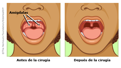 Antes y después de la amigdalectomía