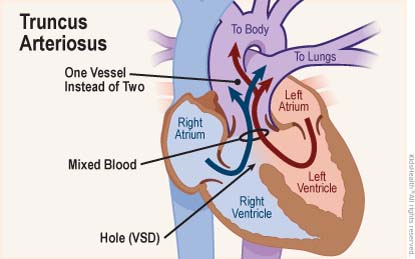Cross section diagram of the heart shows truncus arteriosus — a birth defect where only one blood vessel comes out of the heart (instead of two, the aorta and the pulmonary artery) and a hole (VSD) together allow mixed blood to leave the heart.