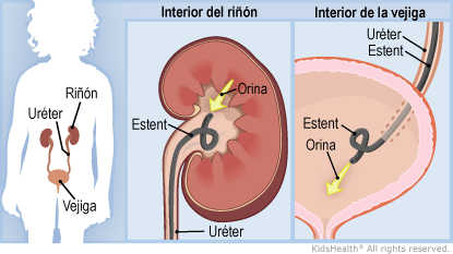 Illustration: ureteral stent