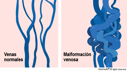 Se muestran venas normales y venas más grandes y enredadas cuando hay una malformación venosa.