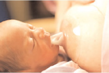 Using a nipple shield with a breastfed baby - ABM