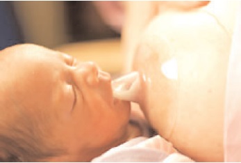 Breastfeeding Your Premature Baby with a Nipple Shield