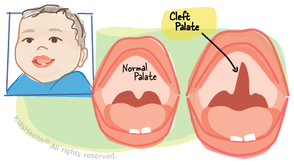 Cleft Lip And Cleft Palate: Most Up-to-Date Encyclopedia, News & Reviews