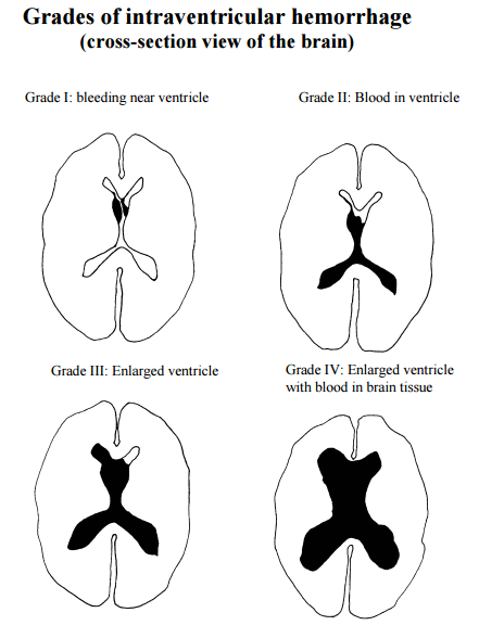 Intraventricular hemorrhage in premature babies : Neonatal Journey to Home